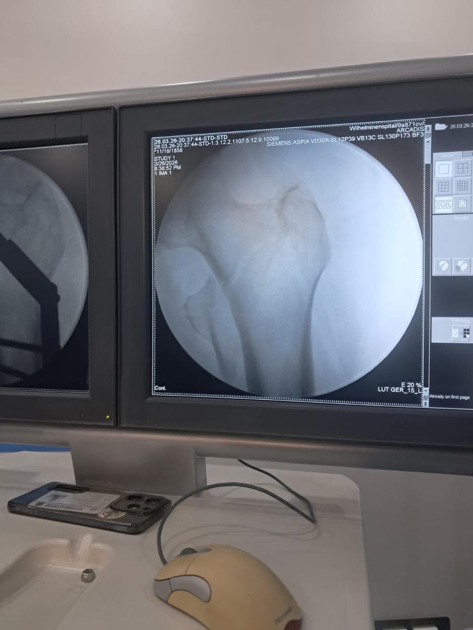 Spine surgery
